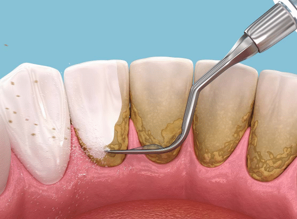5 Ways To Reduce Plaque Around Deep Tooth Grooves
