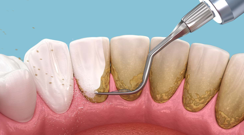 5 Ways To Reduce Plaque Around Deep Tooth Grooves