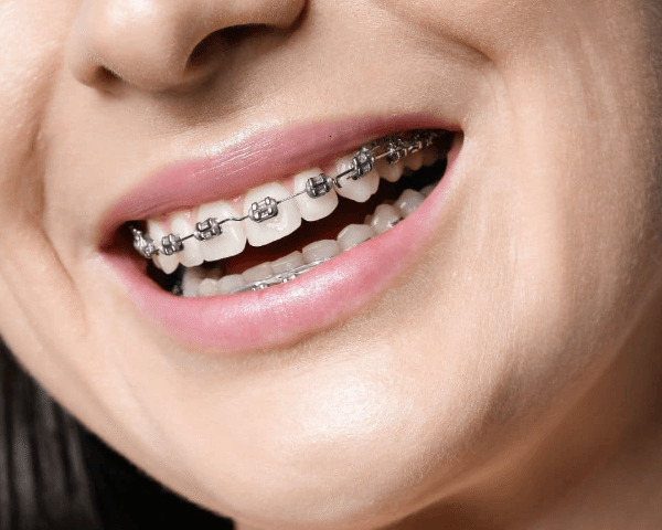 4 Ways Periodontics Improve The Longevity Of Orthodontic Results