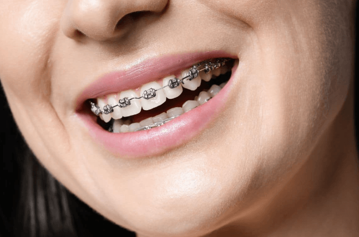 4 Ways Periodontics Improve The Longevity Of Orthodontic Results
