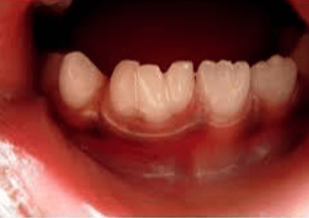 How Pediatric Dentists Evaluate Teeth That Appear Fused Or Joined Together