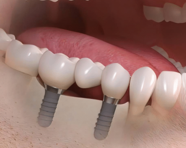 7 Details That Influence The Look Of An Implant Supported Smile
