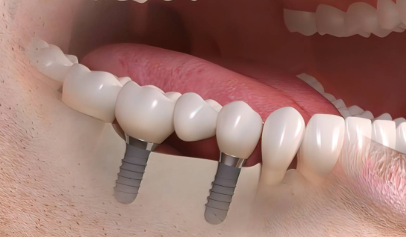 7 Details That Influence The Look Of An Implant Supported Smile