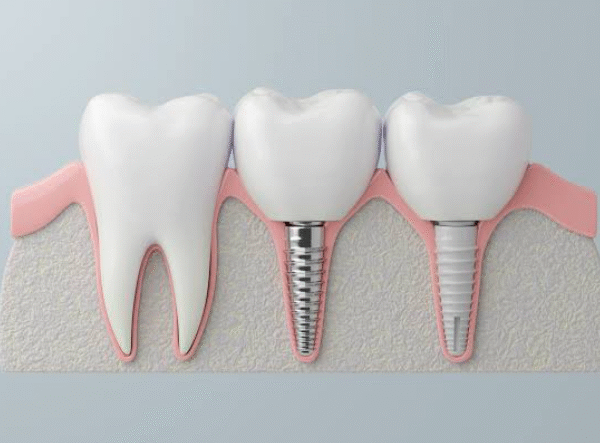 Why Technology is Revolutionizing Periodontics and Implant Dentistry