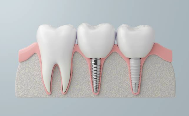 Why Technology is Revolutionizing Periodontics and Implant Dentistry